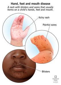 hand foot and mouth blister illustration