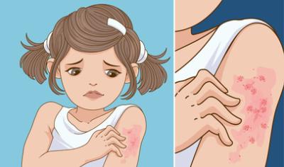 illustration of girl with scabies rash on arm itching scratching discomfort